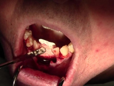 Ekstrakcja zęba #24/25 z augmentacją grzbietu wyrostka za pomocą błony zaporowej i Emdogainu