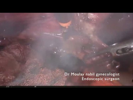 Głęboko naciekająca endometrioza, ureteroliza, resekcja krzyżowo-maciczna