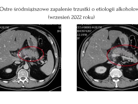 EUS z oceną pozapalnych zmian torbielowatych pola trzustkowego