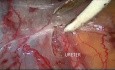 Limfadenektomia węzłów chłonnych miednicznych metodą laparoskopową z powodu raka endometrium