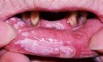 Hyperkeratose der Lippe [Leukoplakie]