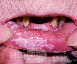 Hiperkeratoza wargi (leukoplakia)