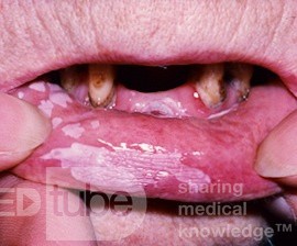 Hiperkeratoza wargi (leukoplakia)