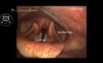 Endoskopowa anatomia laryngologiczna