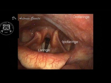 Endoskopowa anatomia laryngologiczna