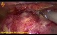 Torakolaparoskopowa ezofagektomia - Część 1