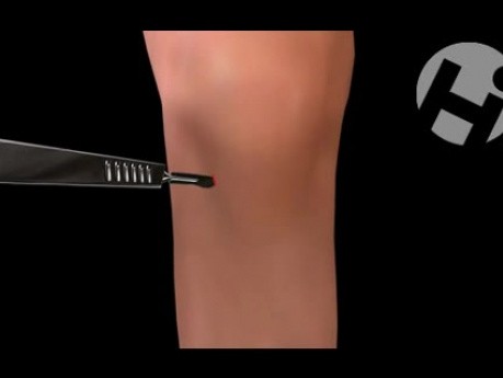 Artroskopia kolana