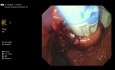Transoralna fundoplikacja bez nacięć (TIF)