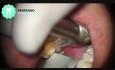 Diagnostyka pęknięcia zęba pod mikroskopem