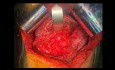 Zakrzepica i pseudoguzy wątroby: Skomplikowana operacja Klatskina typu 3a