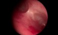 Fistule Trachéo-Vasculaire chez un Nourrisson Présentant des Infections Respiratoires Basses Récidivantes