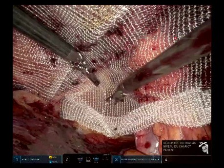Modyfikacja Inana techniki TRAPPIST w naprawie przepukliny okołostomijnej urostomii typu Brickera