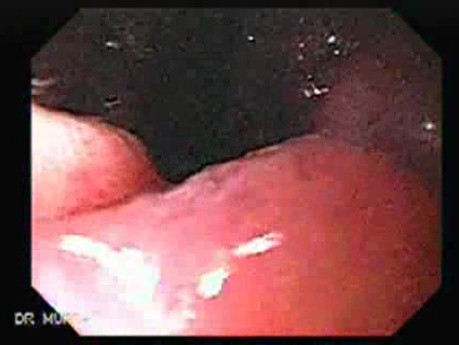Rak żołądka - endoskopia (7 z 15)
