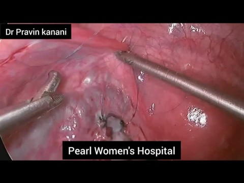 Laparoscopia