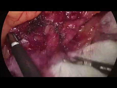 Sigmoidektomia metodą laparoskopową. Mobilizacja zagięcia śledzionowego okrężnicy (całe nagranie)