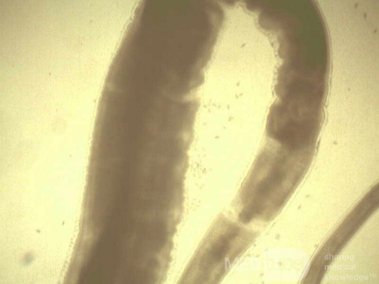Kolonoskopowa obserwacja włosogłówki w jelicie ślepym (7 z 8)