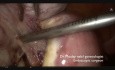 Miomektomia laparoskopowa w trybie nagłym z powodu krwawienia