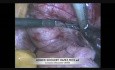 Laparoskopowa resekcja mięśniaka więzadła szerokiego macicy