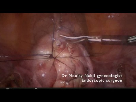 Ambulatoryjna laparoskopowa miomektomia