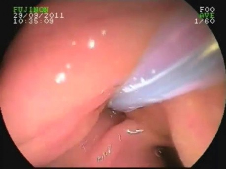 Gruczolakorak brodawki Vatera - endoskopowa ocena i usunięcie