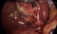 Warianty anatomiczne wykryte w obrazowaniu fluorescencyjnym ICG podczas codziennych cholecystektomii