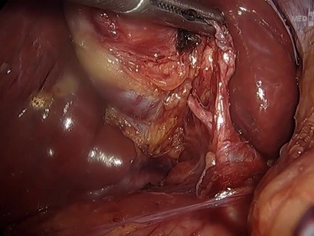 Warianty anatomiczne wykryte w obrazowaniu fluorescencyjnym ICG podczas codziennych cholecystektomii