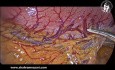 Gastrectomie Sleeve Laparoscopique 