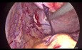 Miomektomia laparoskopowa