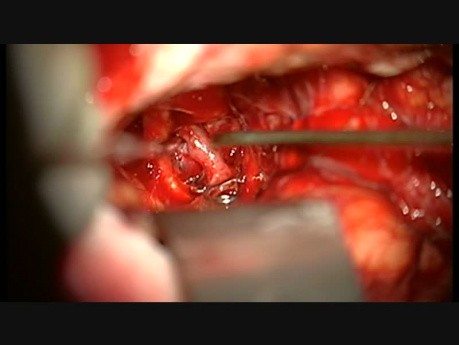Krwawienie z tętniaka podczas klipsowania