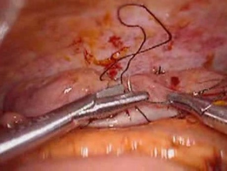 Perforacja okrężnicy z zapaleniem otrzewnej - laparoskopia (15 z 46)