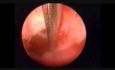 Gruczolakorak błony śluzowej macicy- celowana biopsja