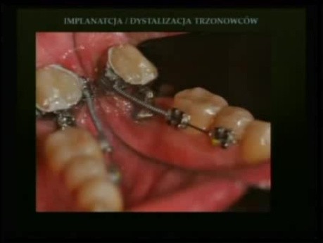 Skojarzone leczenie orto-perio-implantologiczne. Doświadczenia własne - część 6