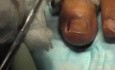 Stopień 3 wrośniętego paznokcia u palca nogi: elektrokauteryzacja