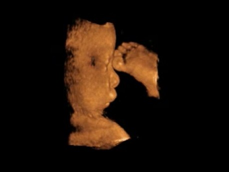 Rozszczep wargi - obraz ultrasonograficzny 3D