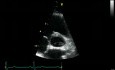 Prawidłowa echokardiografia, obraz w osi przymostkowej na poziomie aorty
