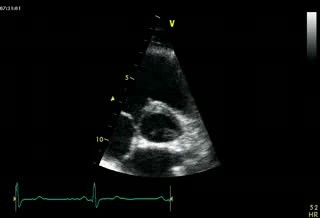 Prawidłowa echokardiografia, obraz w osi przymostkowej na poziomie aorty