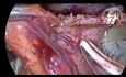 Laparoskopowa kardiomiotomia sposobem Hellera