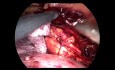 Retroperitoneal Laparoscopic Adrenalectomy (Pheochromocytoma) 