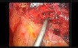 Wideotorakoskopowa rękawowa resekcja z jednego cięcia płata górnego płuca lewego