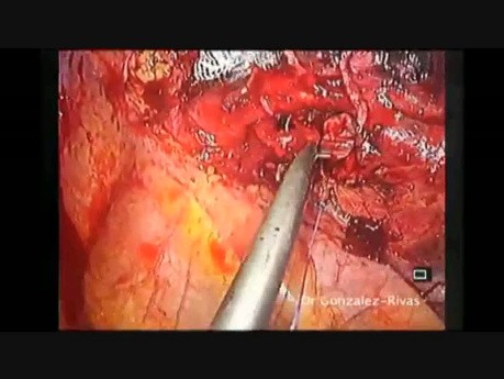 Wideotorakoskopowa rękawowa resekcja z jednego cięcia płata górnego płuca lewego