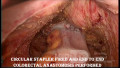 Niska przednia laparoskopowa resekcja odbytnicy z powodu raka odbytnicy: krok po kroku 