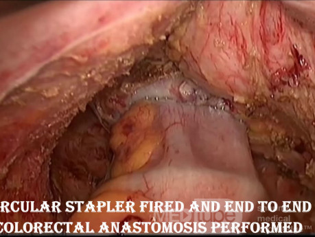 Niska przednia laparoskopowa resekcja odbytnicy z powodu raka odbytnicy: krok po kroku 