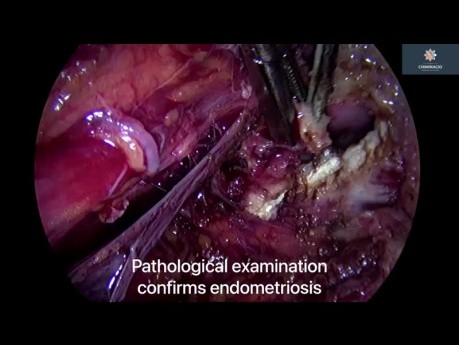 Endometrioza z zajęciem przymacicza i rozlanym zajęciem otrzewnej - peritonektomia tylnego przedziału (posterior compartment peritonectomy)