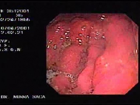 Dziedziczny rozlany rak żołądka (HDGC) - endoskopia (4 z 4)