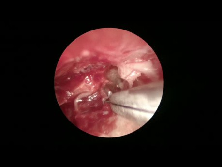 Leczenie perlaka: podejście endoskopowe i mikroskopowe