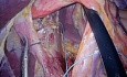 Operacja laparoendoskopowa LESS przepukliny rozworu przełykowego i fundoplikacja Nissena