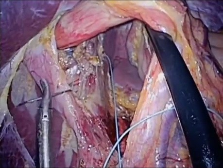 Operacja laparoendoskopowa LESS przepukliny rozworu przełykowego i fundoplikacja Nissena