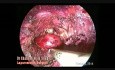 Endoskopowa przezpachowa tyreoidektomia