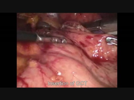 Laparoskopowa rękawowa resekcja z powodu GISTu żołądka