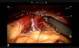 Robotowa rękawowa resekcja żołądka